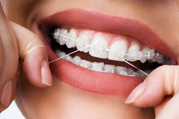 Clear Braces, Aligners, And Other Discreet Orthodontic Treatments