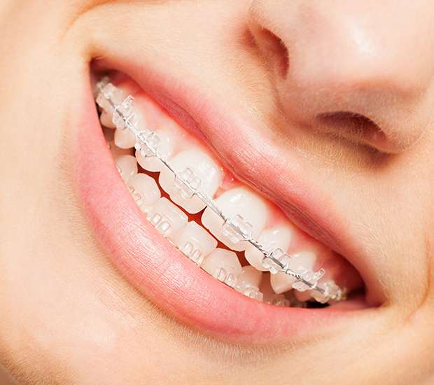 Lilburn Clear Braces