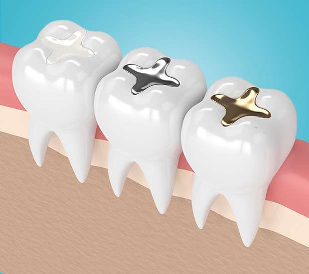 Lilburn Composite Fillings