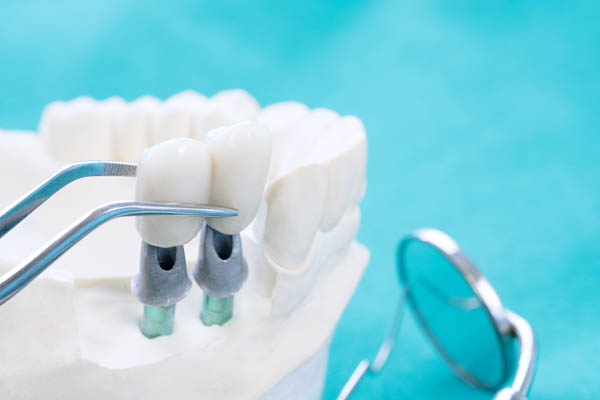 How Traditional Dental Crowns And Implant Crowns Differ