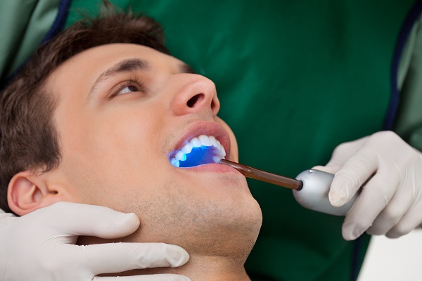 When Should You Get Dental Fillings?