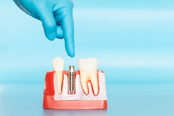 What Does The Process For Dental Implants Involve?