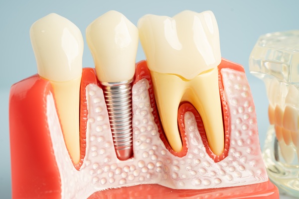 A Guide To Partial And Full Arch Dental Implants