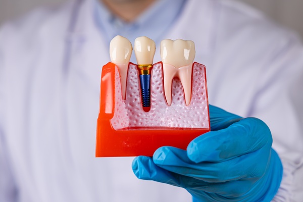 A Dental Implant Is A Permanent Tooth Replacement