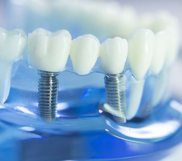 Lilburn Dental Implants