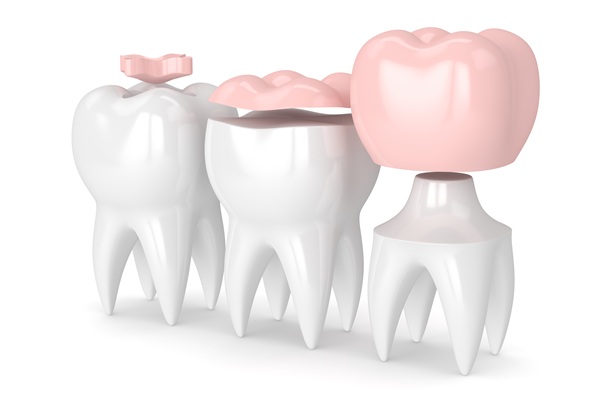 Dental Inlay, Onlay, Fillings, Or Crowns: Which Is Best For You?