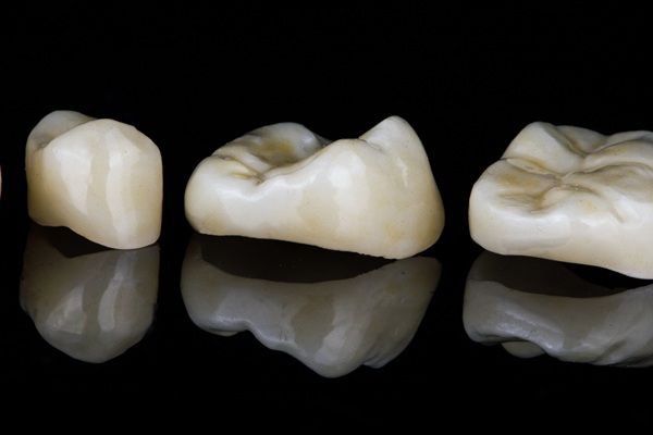 Dental Onlay Advantages: Conservative Restorations That Preserve Natural Structure