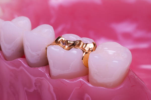 Are Dental Sealants Effective Against Tooth Decay?