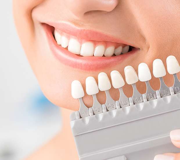 Lilburn Dental Veneers and Dental Laminates