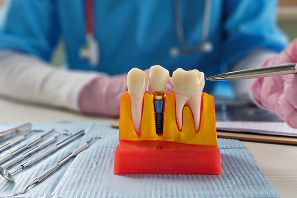 Implant Crown: The Final Step In Restoring Your Smile