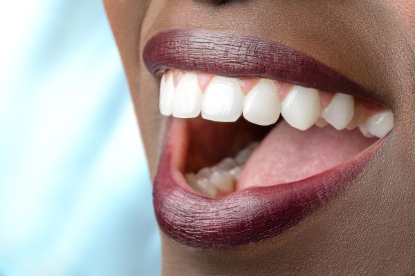 professional teeth whitening Lilburn, GA