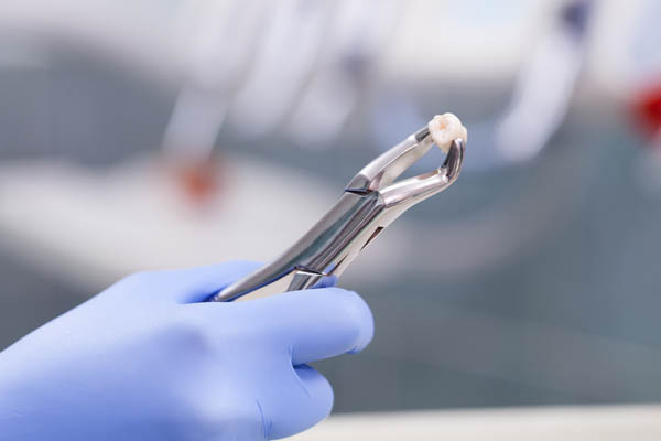 Tooth Extraction Is A Common General Dentistry Procedure