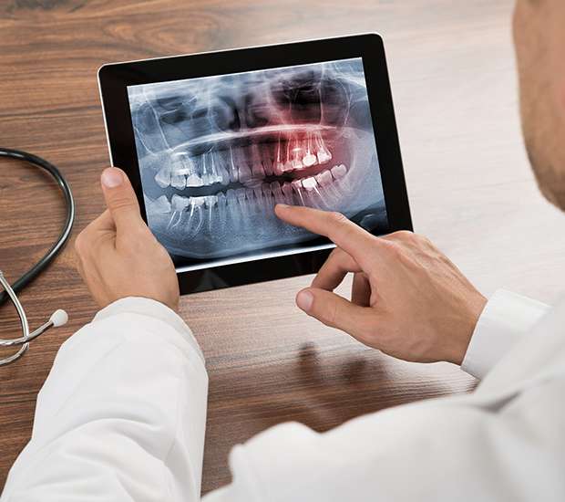 Lilburn Types of Dental Root Fractures